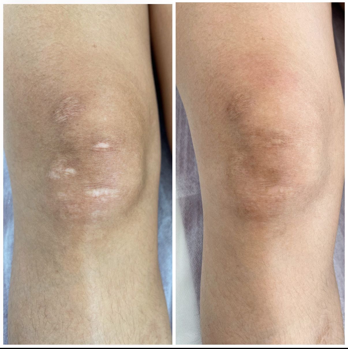 Skin texture revision