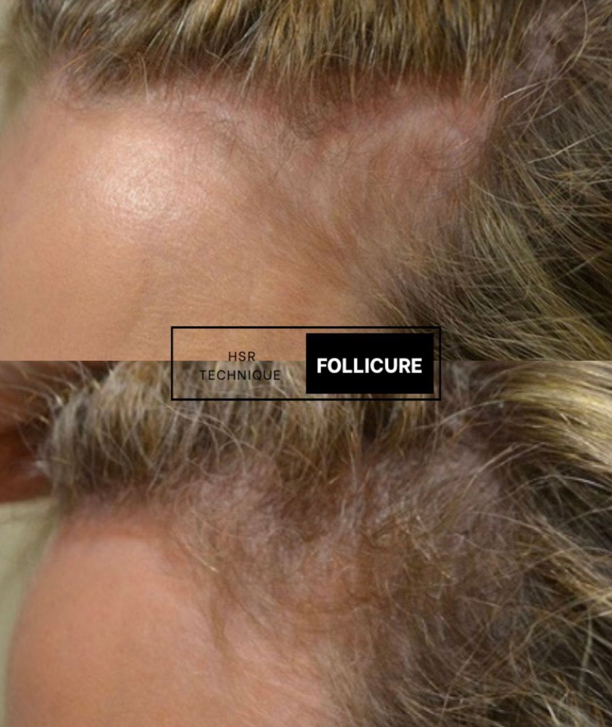 Scar camouflage result