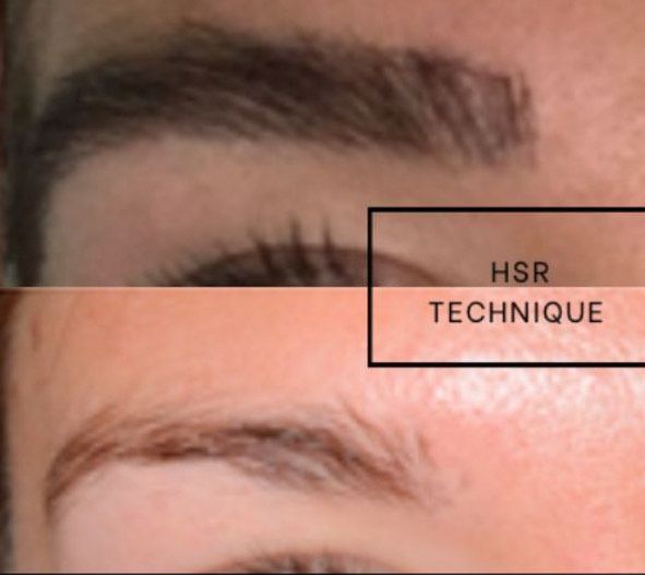 Stretch mark revision result