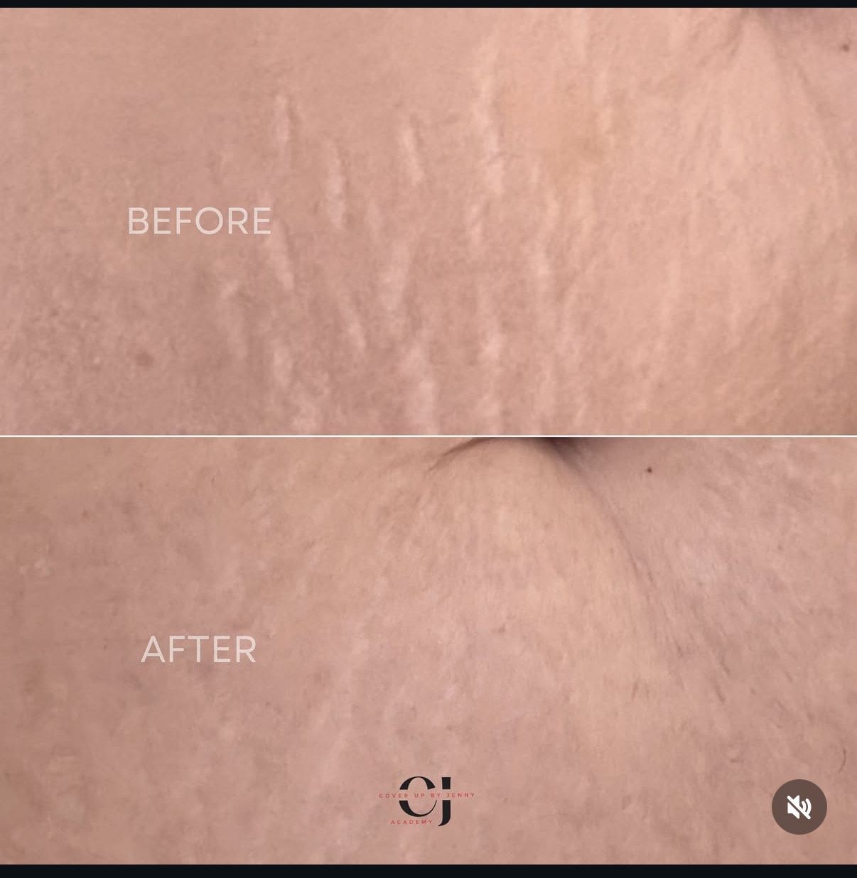 Before and after scar revision