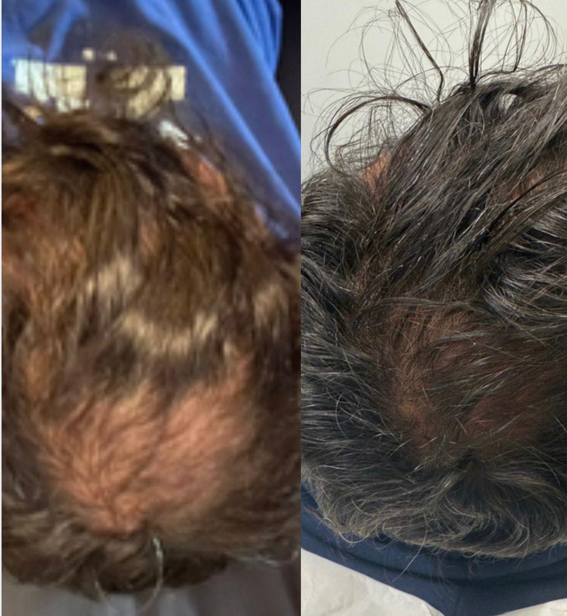 Skin ReNUE before and after — paramedical tattooing result