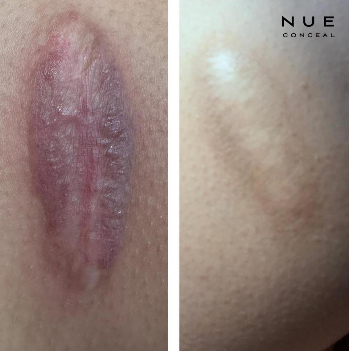 Skin ReNUE before and after — paramedical tattooing transformation