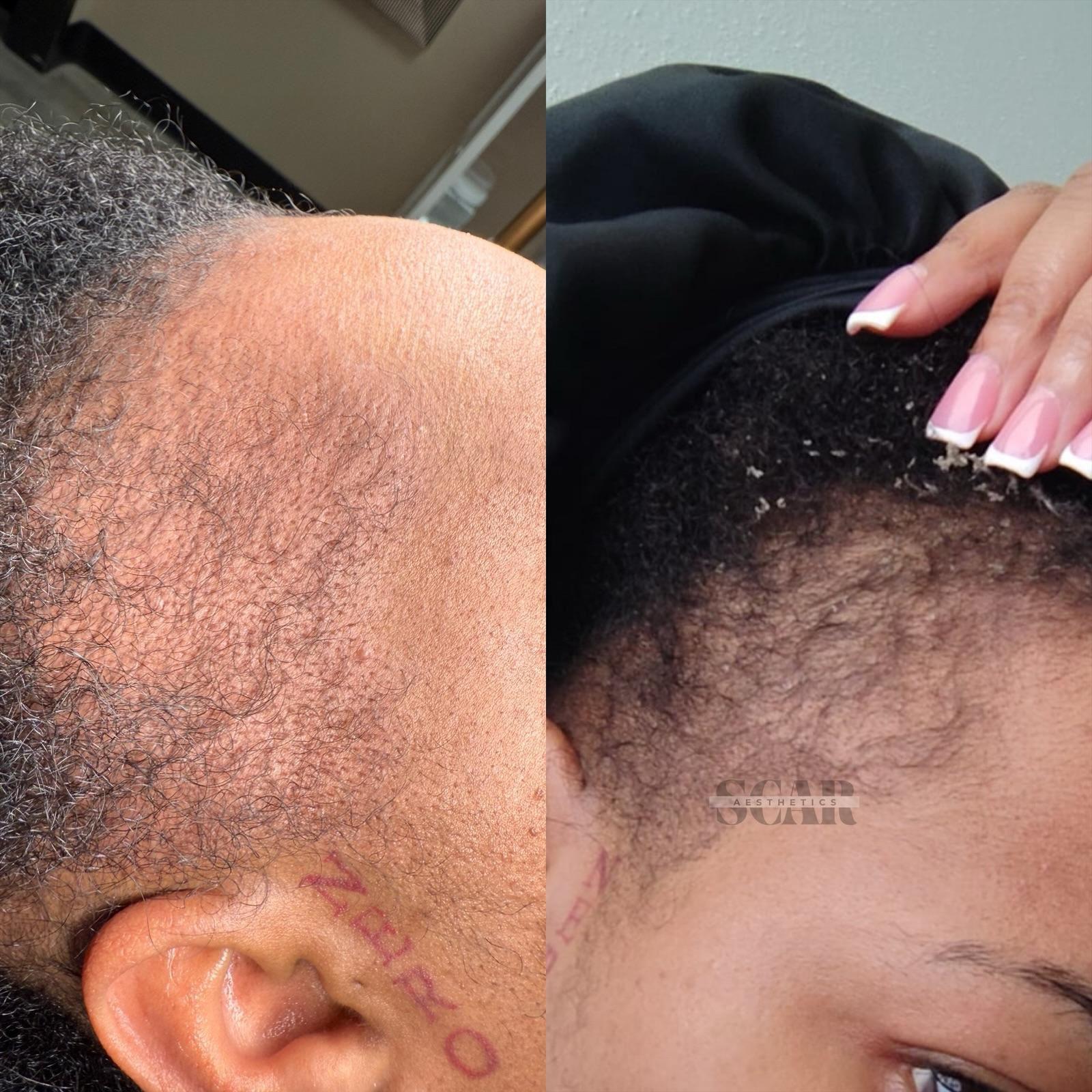 Skin ReNUE before and after — scar revision result