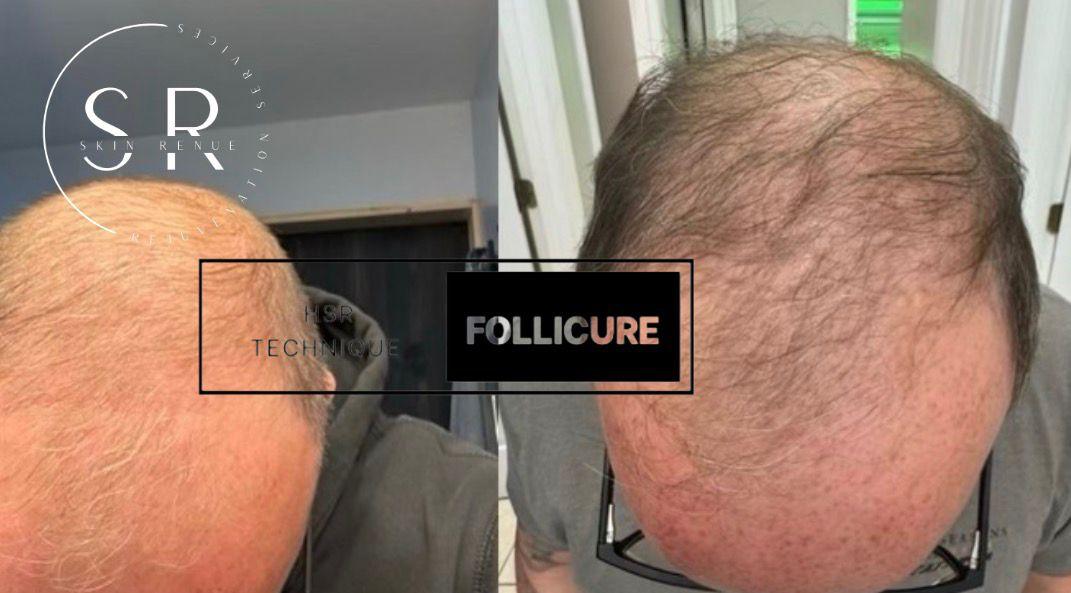 Skin ReNUE before and after — paramedical tattooing transformation