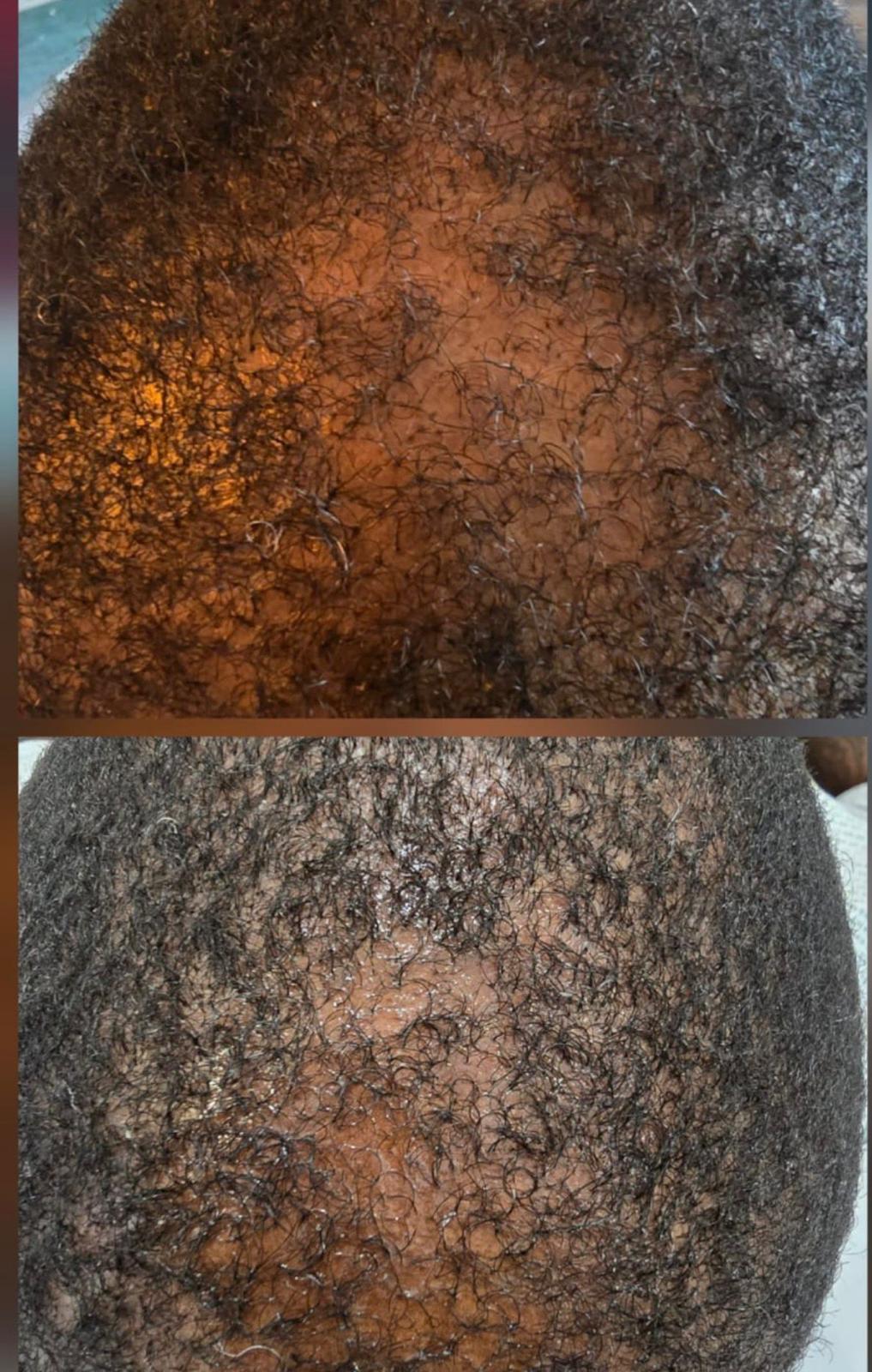 Skin ReNUE before and after — stretch mark camouflage result