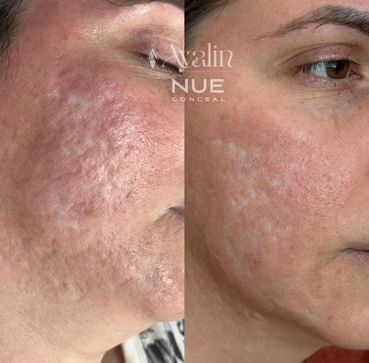 Skin ReNUE before and after — paramedical tattooing transformation