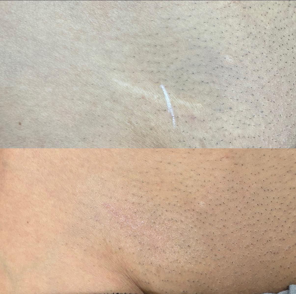 Skin ReNUE before and after — inkless revision result