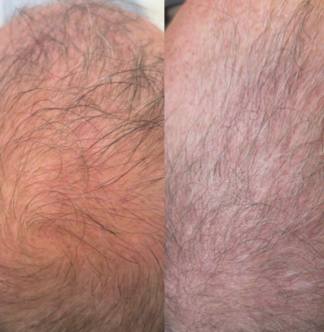 Skin ReNUE before and after — paramedical tattooing transformation