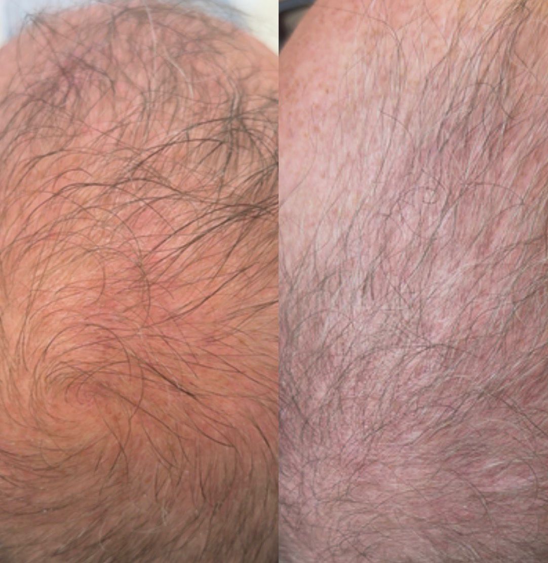 Skin ReNUE before and after — paramedical tattooing result