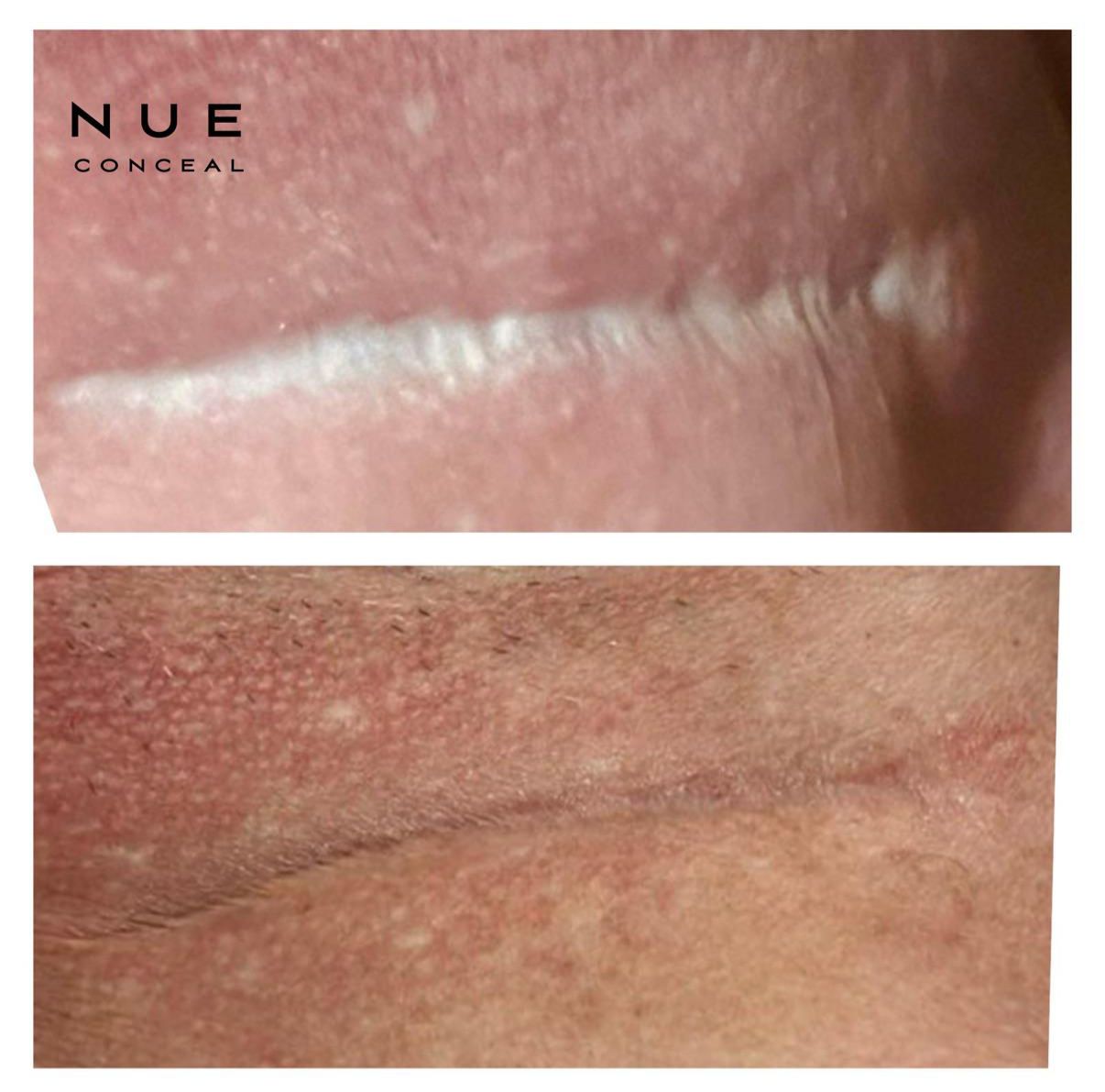 Skin ReNUE before and after — paramedical tattooing transformation