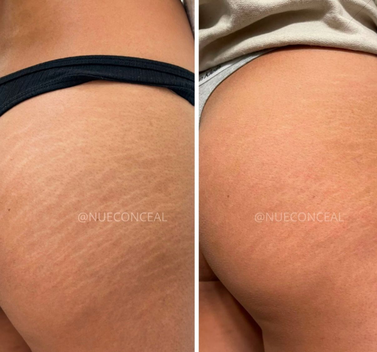 Skin ReNUE before and after — scar camouflage result