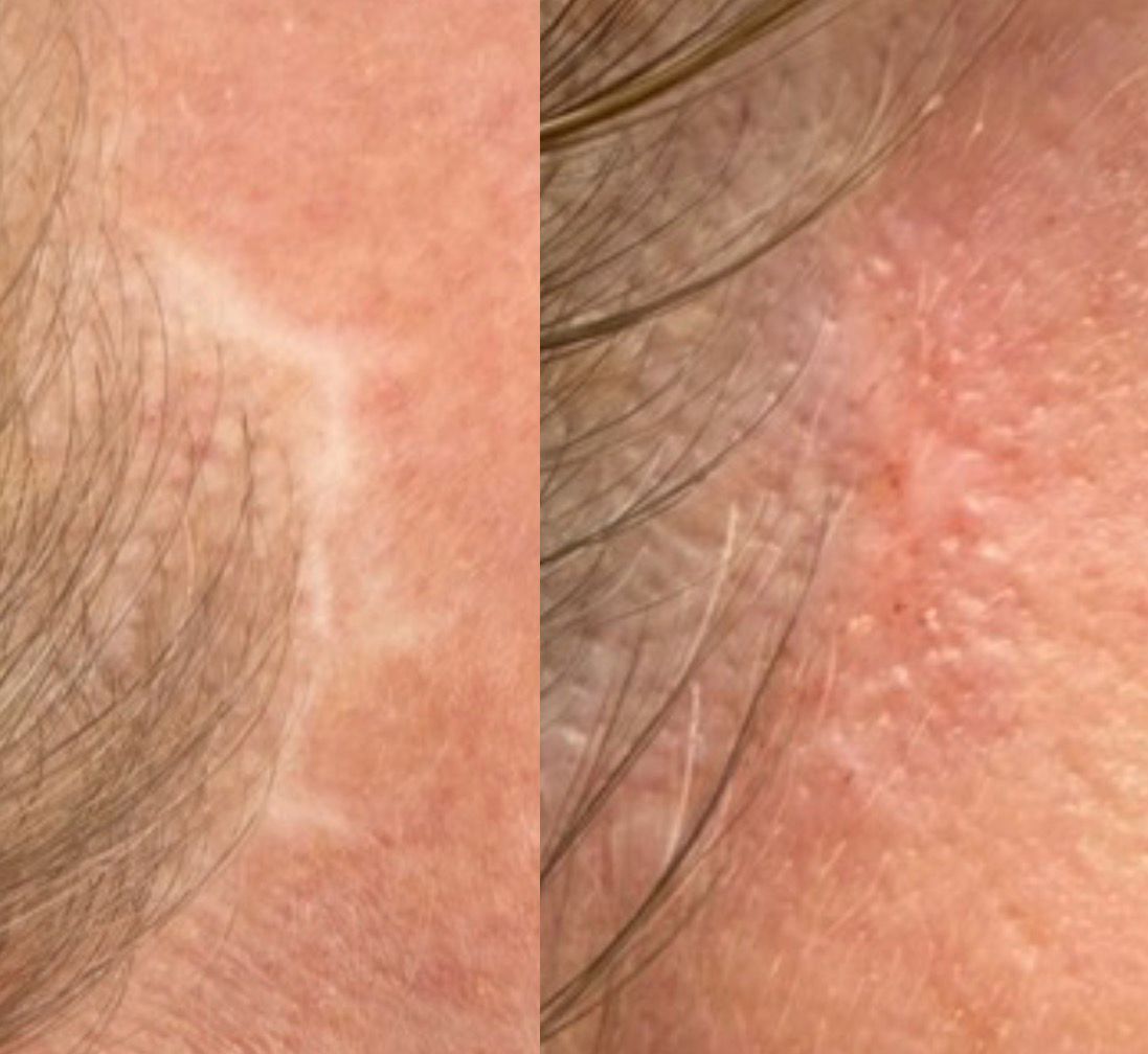 Skin ReNUE before and after — paramedical tattooing transformation