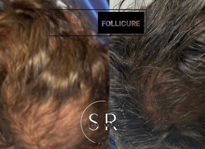 Skin ReNUE before and after — paramedical tattooing transformation