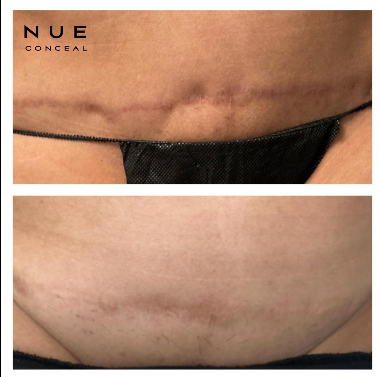 Skin ReNUE before and after — paramedical tattooing transformation