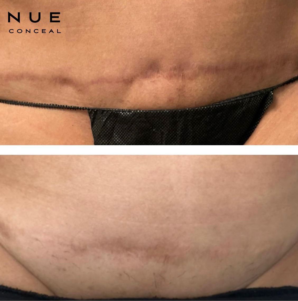 Skin ReNUE before and after — paramedical tattooing transformation