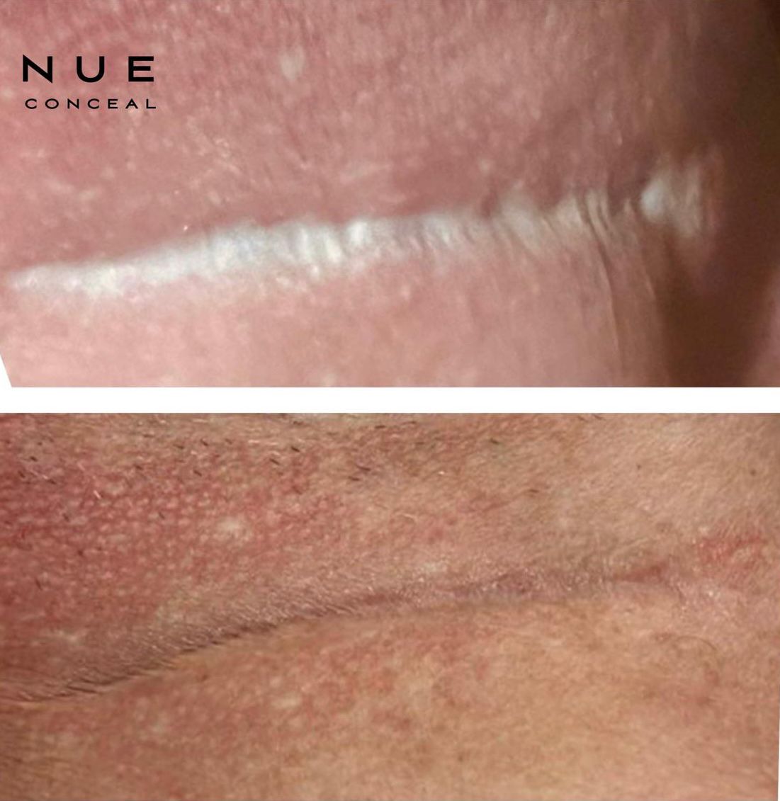 Skin ReNUE before and after — paramedical tattooing transformation