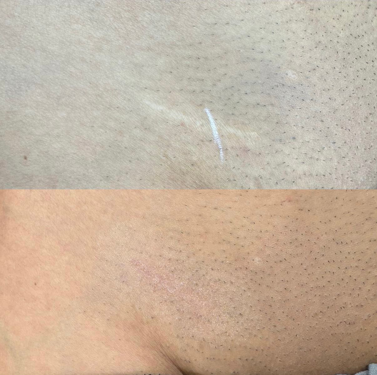 Skin ReNUE before and after — paramedical tattooing transformation