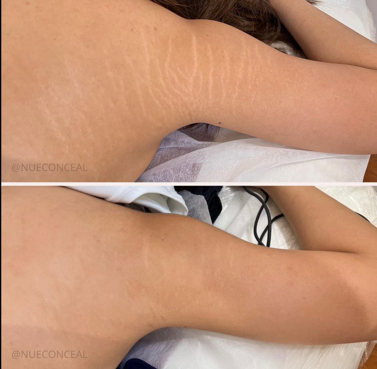 Skin ReNUE before and after — paramedical tattooing transformation